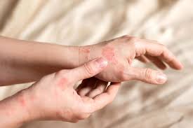 What Causes Eczema Flare-Ups in Adults? (And What Actually Helps)